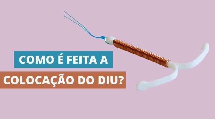 Imagem representativa sobre como é feita a colocação do DIU.