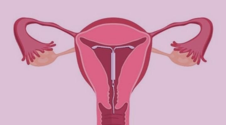 Imagem sobre o que é DIU.